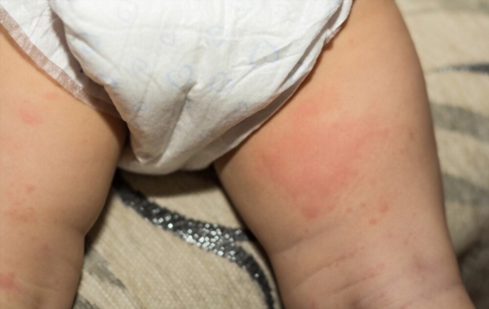 Top 5 Home Remedies to Cure Diaper Rash Treatment at Home